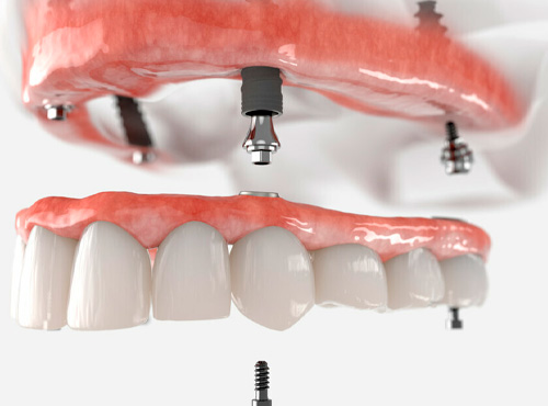 Implantes Dentários em Guarulhos