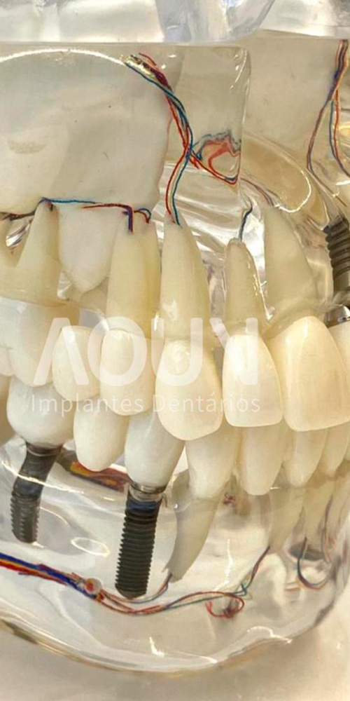 Implantes Dentários - Guarulhos