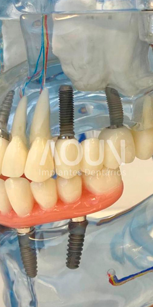 Implantes Dentários - Guarulhos